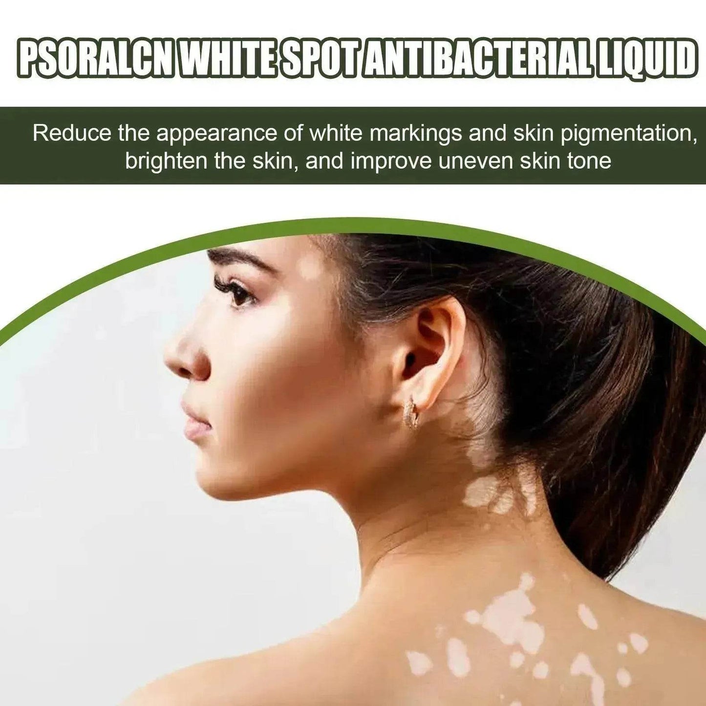 EELHOE White Spot Cleansing Serum PSORALCN White Spot Antibacterial Liquid. - Velora