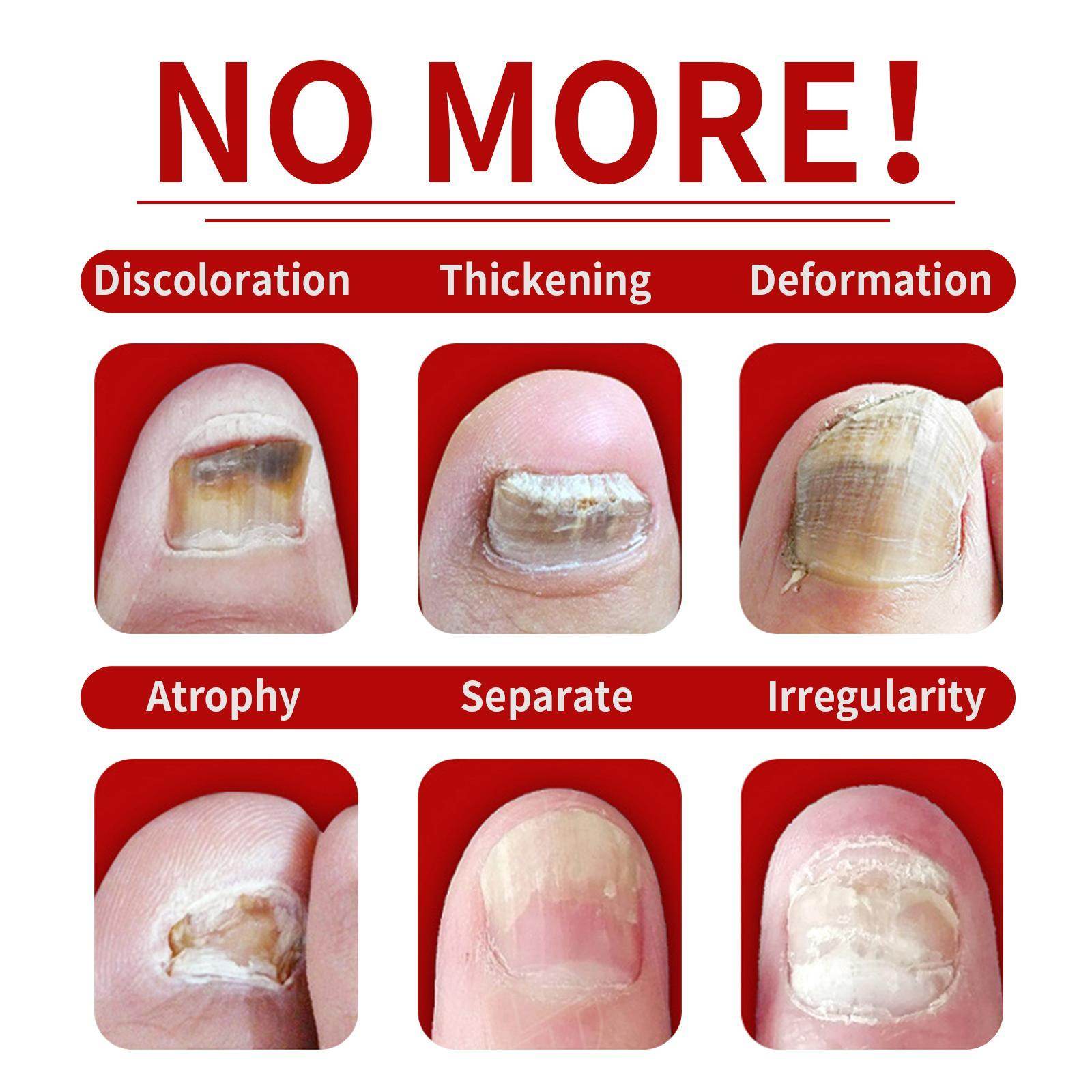 Jiasuying Ginger Nail Care Liquid, Repairs And Moisturizes Hand And Foot Nails, Makes Nails Shiny And Soft, And Improves Onychomycosis - Velora