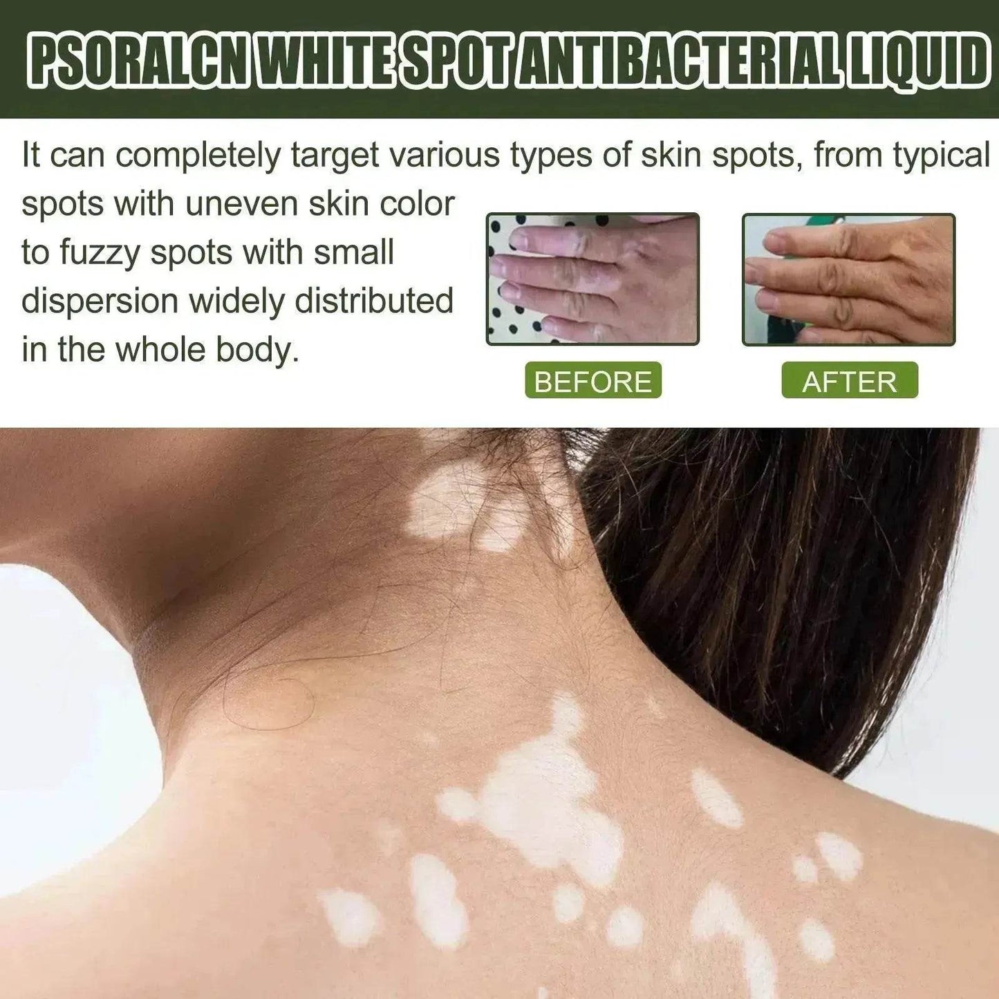 EELHOE White Spot Cleansing Serum PSORALCN White Spot Antibacterial Liquid. - Velora